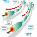 Multiple-Sclerosis