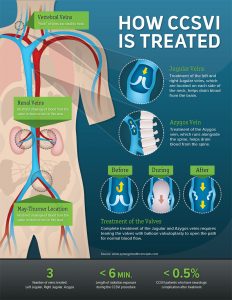 ccsvi-infographic_trattamento