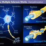 decorso_multiple-sclerosis-demyelinization
